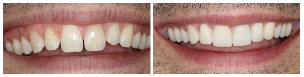Crown Lengthening & Veneers