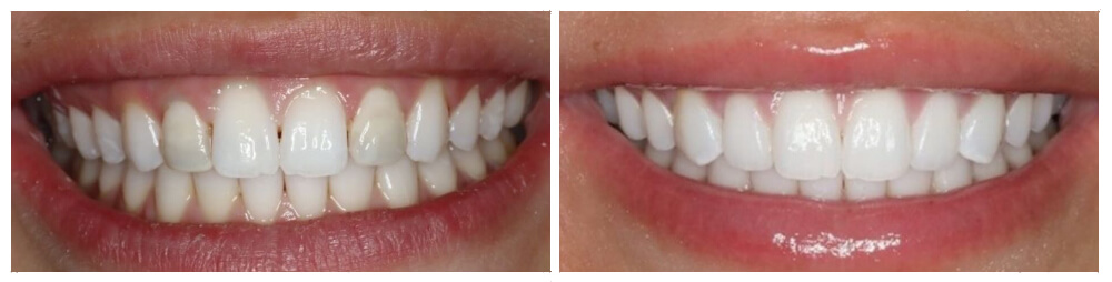 Veneers