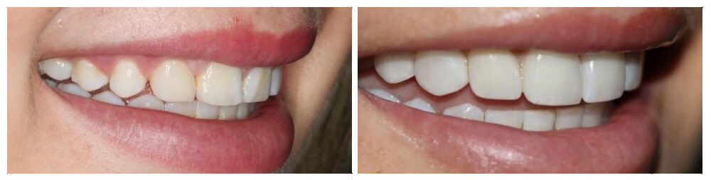 Crown Lengthening & Veneers