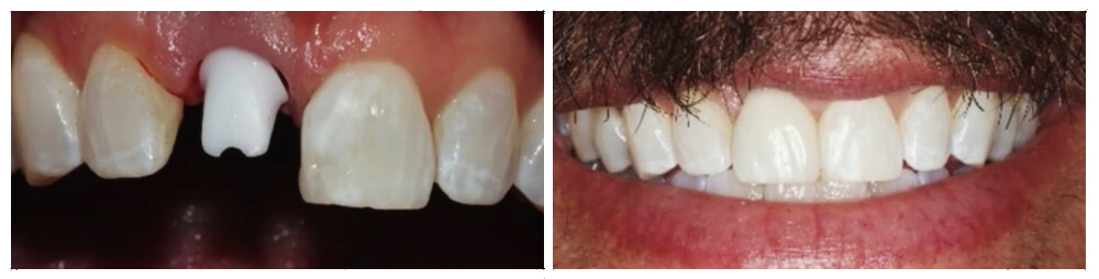 Single Front Implant