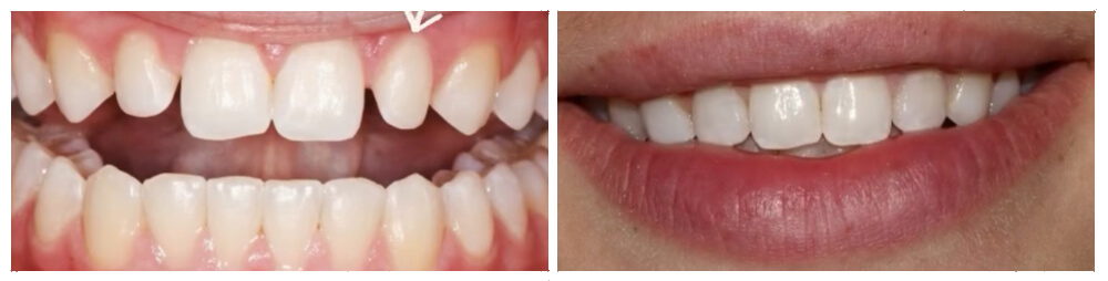Veneers